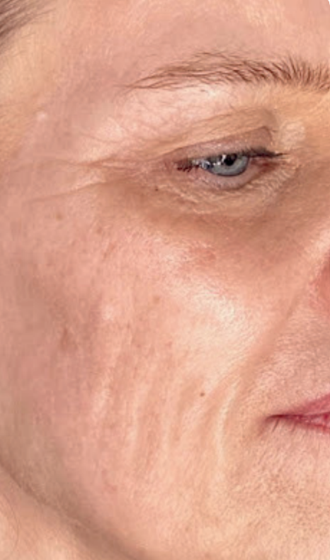 Facial skin after three Neveskin Ultra Lift sessions