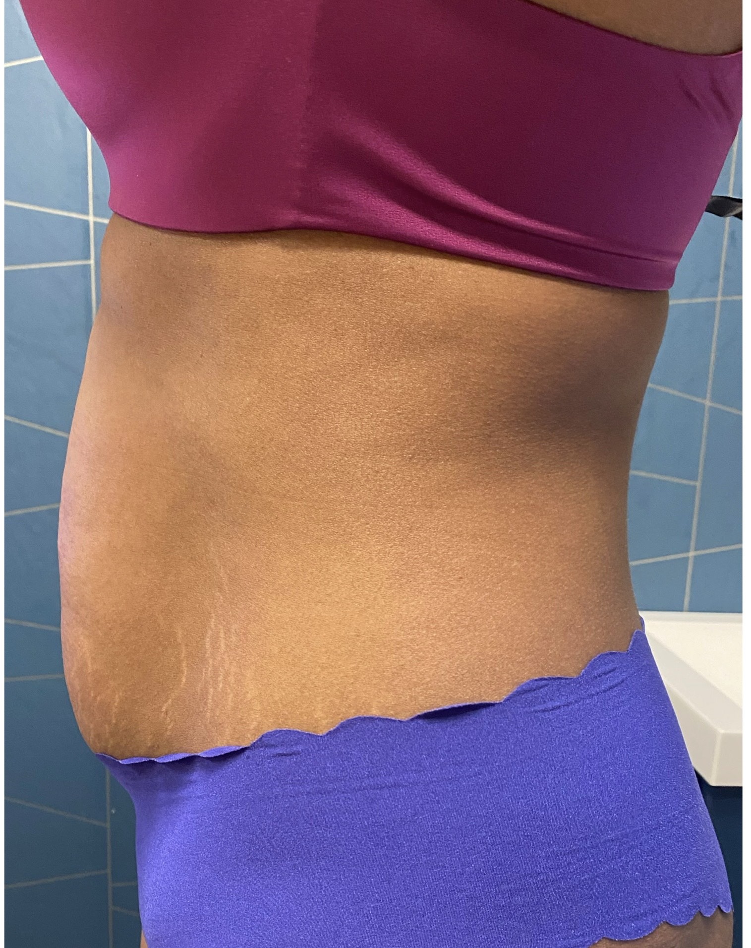 Side view of abdomen after seven Neveskin Shape sessions