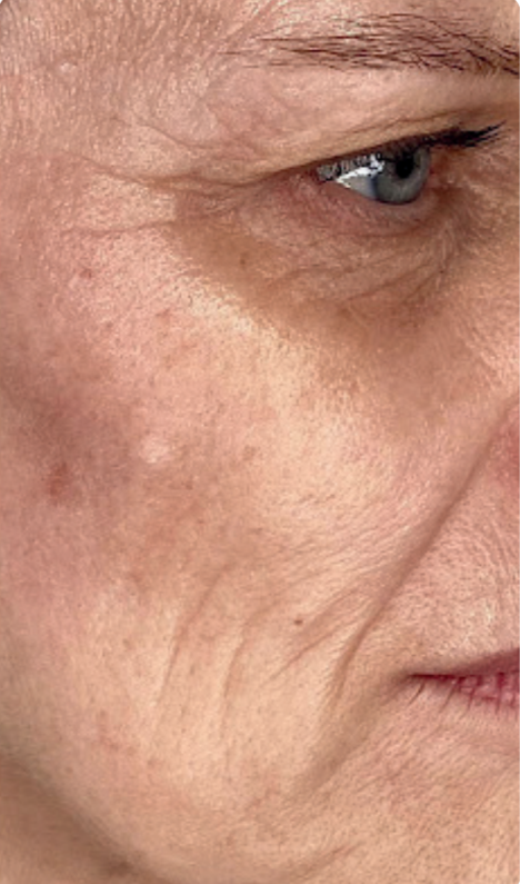 Facial skin before Neveskin Ultra Lift treatment