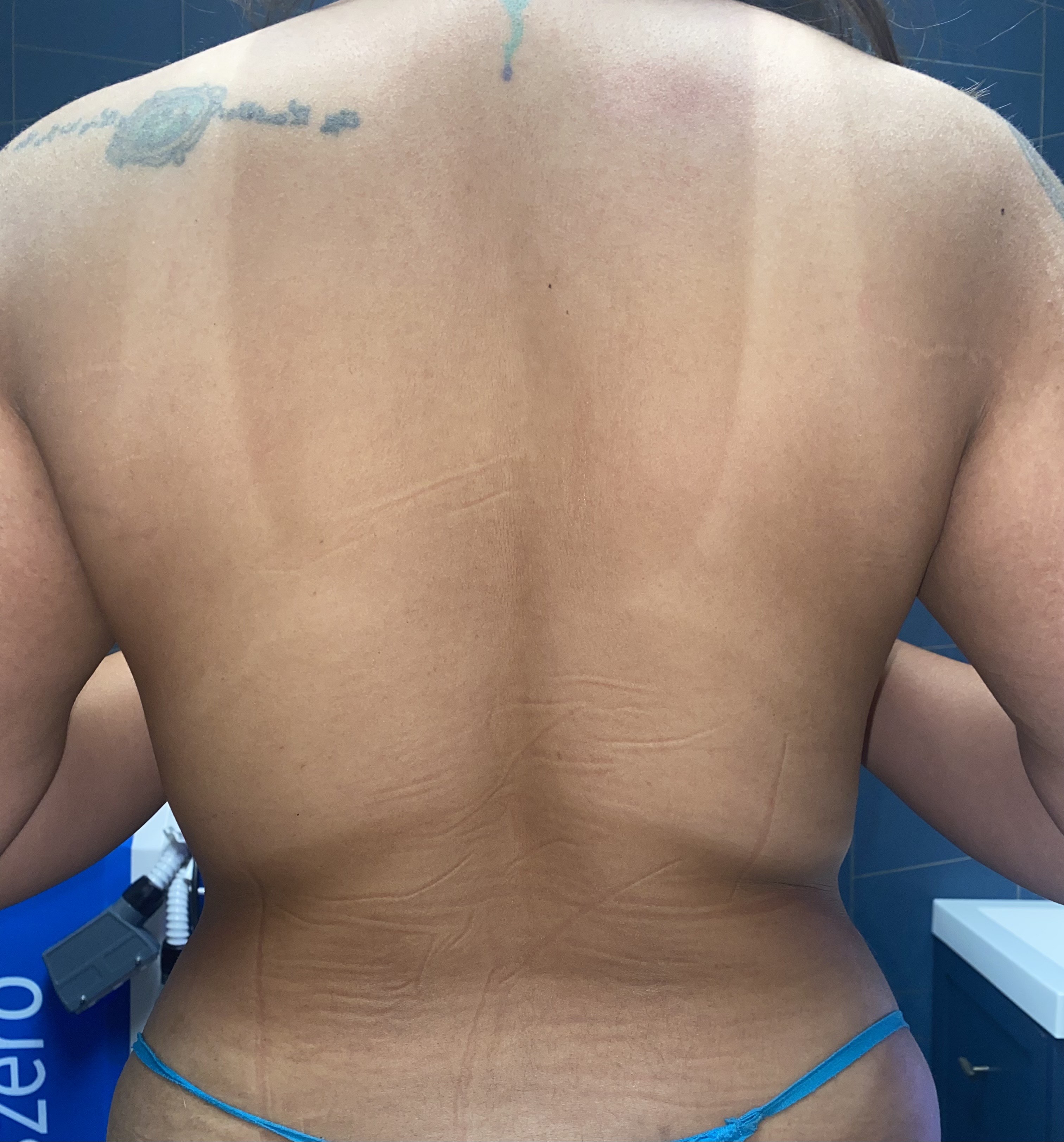 Back view after one lymphatic drainage and two Neveskin Shape sessions