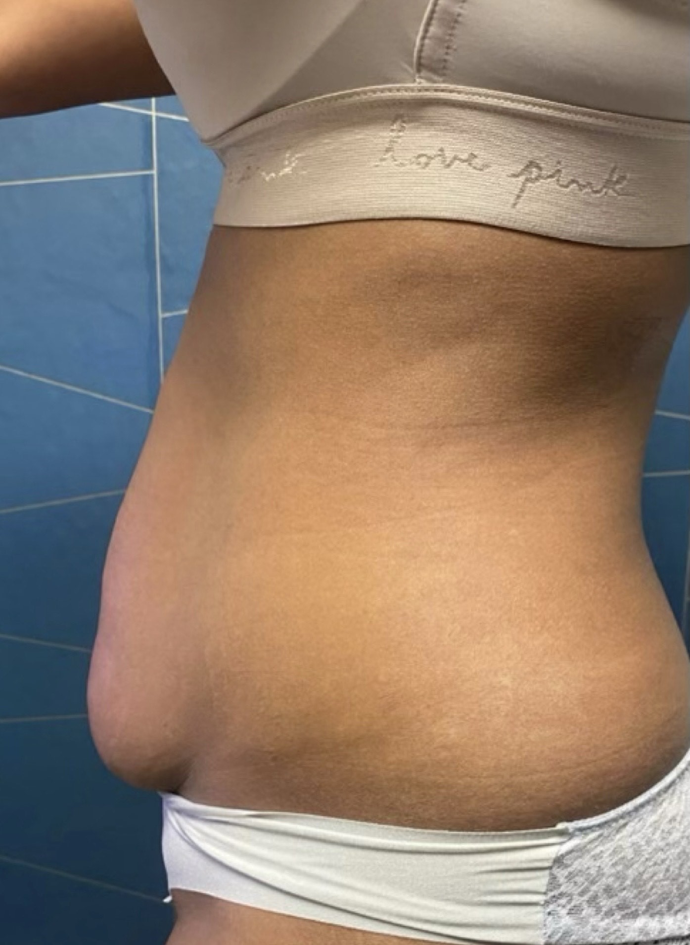 Side view of abdomen before Neveskin Shape treatment